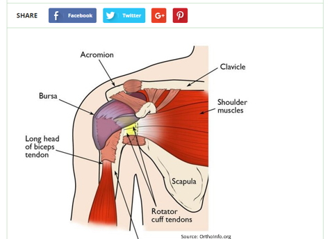 Shoulder impingement