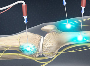 Genicular Nerve Ablation (RF Neurotomy)