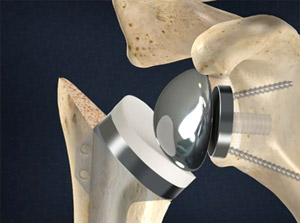 Reverse Total Shoulder Replacement