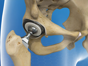 Total Hip Replacement